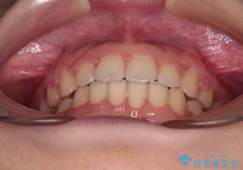 口が閉じられない ワイヤー装置での抜歯矯正の治療後