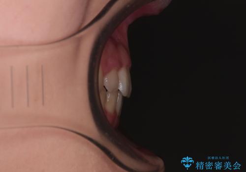 口が閉じられない ワイヤー装置での抜歯矯正の治療後