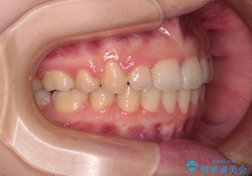 口が閉じられない　ワイヤー装置での抜歯矯正の治療後