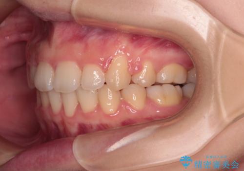 口が閉じられない ワイヤー装置での抜歯矯正の治療後