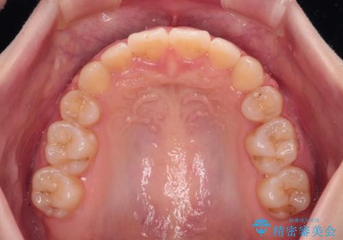 口が閉じられない ワイヤー装置での抜歯矯正の治療後
