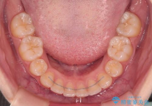 口が閉じられない ワイヤー装置での抜歯矯正の治療後