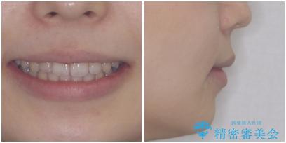 口が閉じられない ワイヤー装置での抜歯矯正の治療後(顔貌)