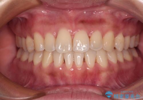 【モニター】前歯のデコボコをインビザラインで改善の症例 治療後
