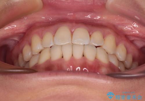 【モニター】前歯のデコボコをインビザラインで改善の治療後