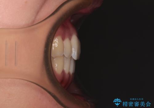 【モニター】前歯のデコボコをインビザラインで改善の治療後