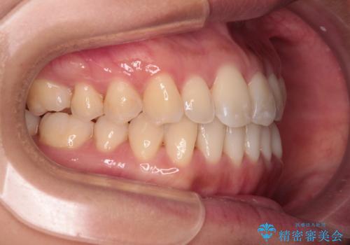 【モニター】前歯のデコボコをインビザラインで改善の治療後
