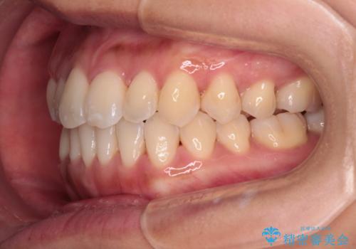 【モニター】前歯のデコボコをインビザラインで改善の治療後