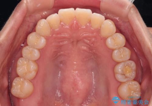 【モニター】前歯のデコボコをインビザラインで改善の治療後