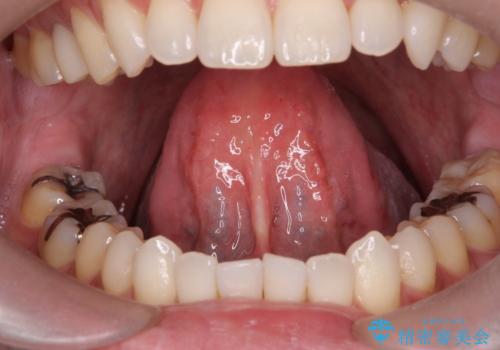 滑舌が気になる　舌小帯の切除の治療前