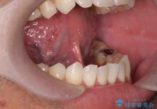 滑舌が気になる　舌小帯の切除の治療前