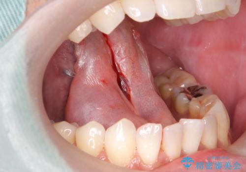 滑舌が気になる 舌小帯の切除の治療中