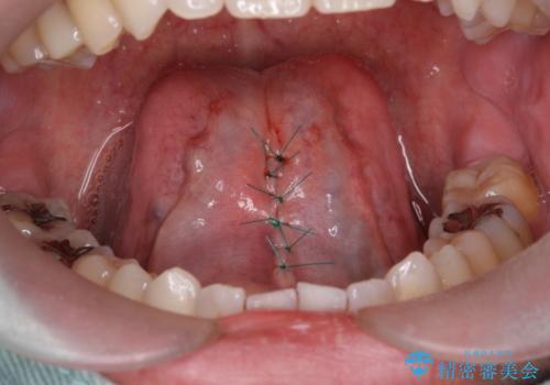 滑舌が気になる 舌小帯の切除の治療中