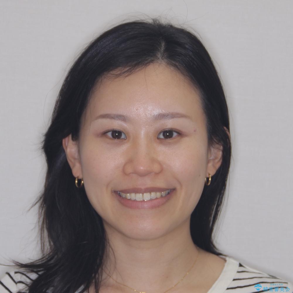 【モニター】前歯のデコボコをインビザラインで改善の治療後(顔貌)