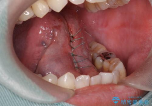 滑舌が気になる 舌小帯の切除の治療中