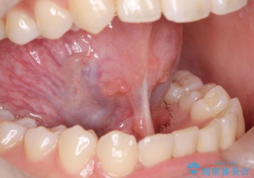 舌小帯切除の症例 治療前