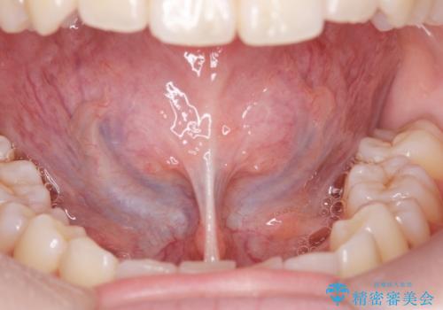 舌小帯切除の治療前