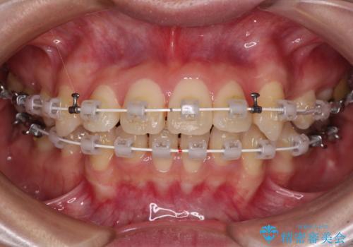 【モニター】口が閉じにくい 抜歯矯正で口元を引っ込めるの治療中