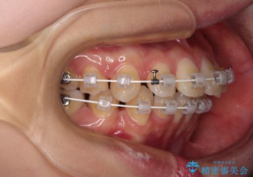 【モニター】口が閉じにくい 抜歯矯正で口元を引っ込めるの治療中