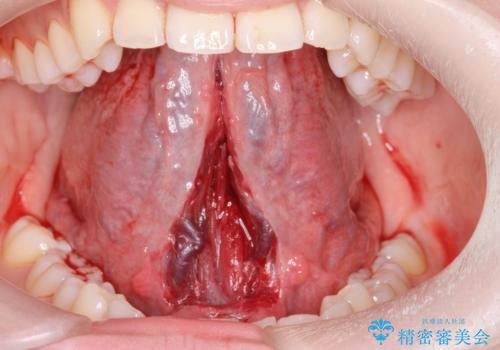舌小帯切除の治療中