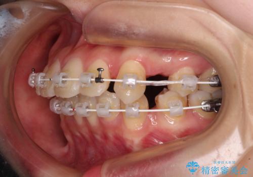 【モニター】口が閉じにくい 抜歯矯正で口元を引っ込めるの治療中