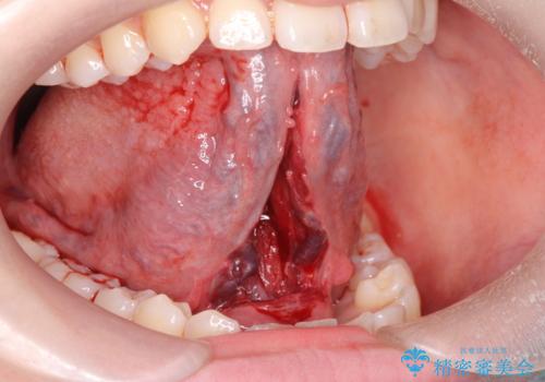 舌小帯切除の治療中