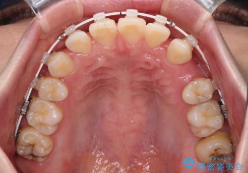 【モニター】口が閉じにくい 抜歯矯正で口元を引っ込めるの治療中