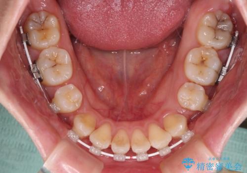 【モニター】口が閉じにくい　抜歯矯正で口元を引っ込めるの治療中