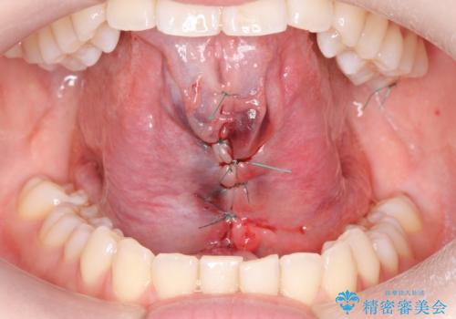 舌小帯切除の治療中