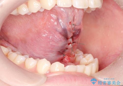 舌小帯切除の治療中