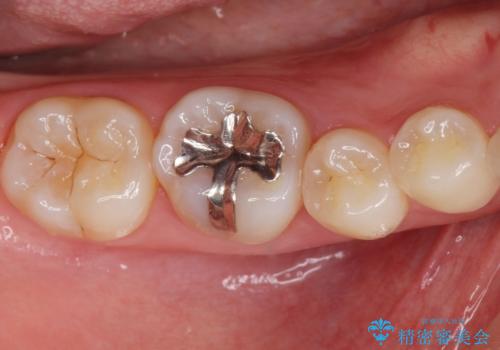 セラミックインレー治療の症例 治療前