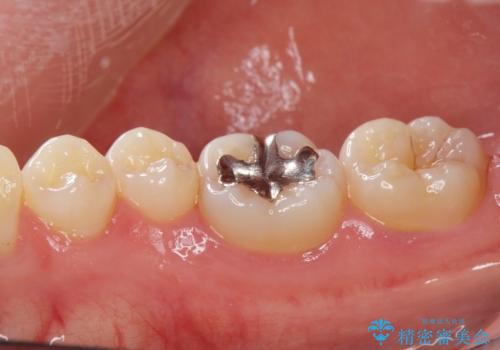 セラミックインレー治療の治療前