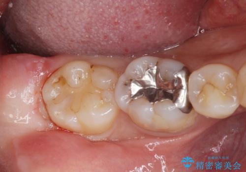 親知らず抜歯の症例 治療前
