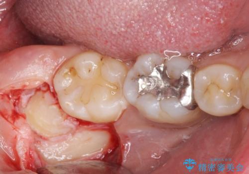 親知らず抜歯の治療中