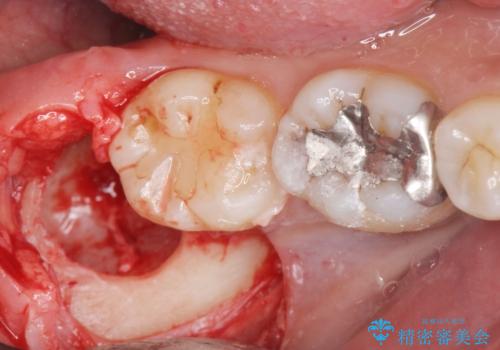 親知らず抜歯の治療中