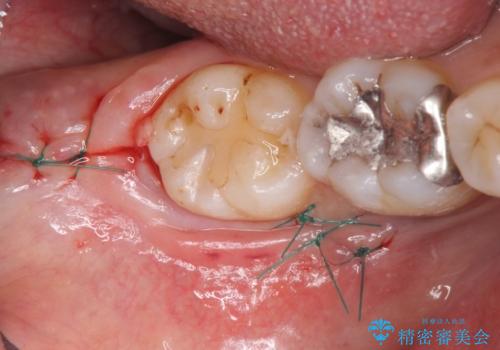 親知らず抜歯の症例 治療後
