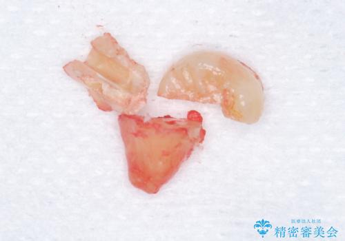 親知らず抜歯の治療中