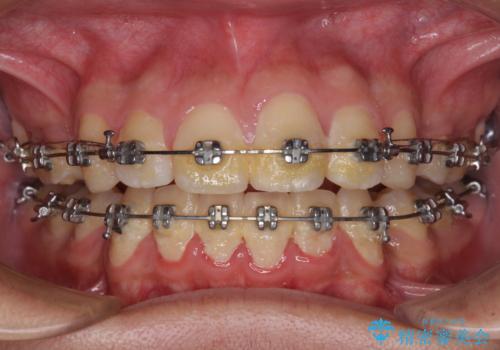 膨らんだ口元 ワイヤー装置での抜歯矯正の治療中