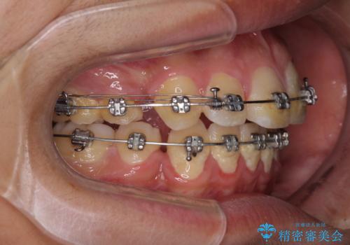 膨らんだ口元 ワイヤー装置での抜歯矯正の治療中