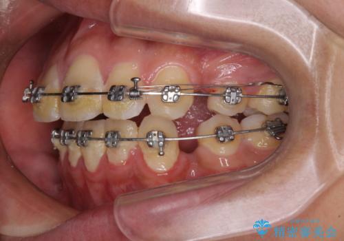 膨らんだ口元 ワイヤー装置での抜歯矯正の治療中