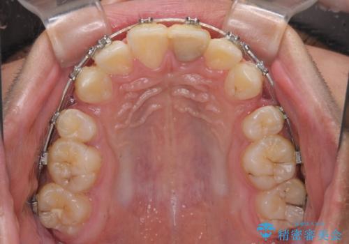 膨らんだ口元 ワイヤー装置での抜歯矯正の治療中