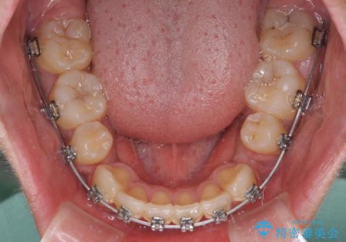 膨らんだ口元 ワイヤー装置での抜歯矯正の治療中
