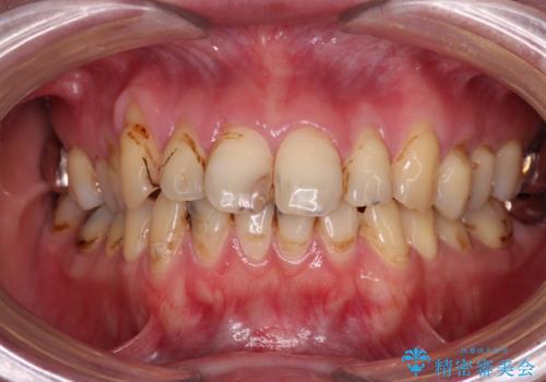 むし歯だらけの前歯をオールセラミッククラウンできれいにの治療前