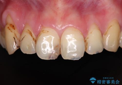 むし歯だらけの前歯をオールセラミッククラウンできれいにの治療前