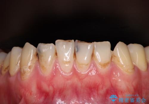 むし歯だらけの前歯をオールセラミッククラウンできれいにの治療前