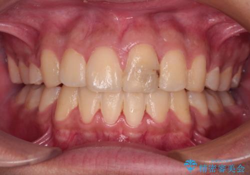 膨らんだ口元 ワイヤー装置での抜歯矯正の治療後