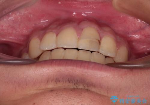 膨らんだ口元 ワイヤー装置での抜歯矯正の治療後