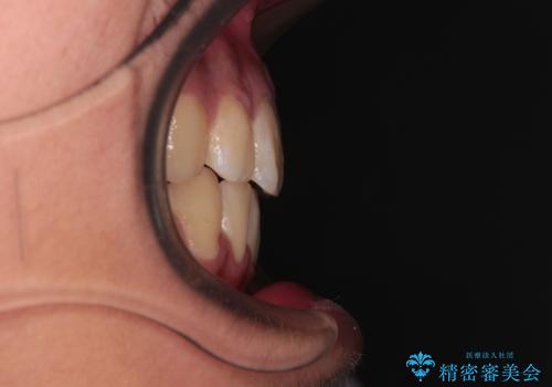 膨らんだ口元 ワイヤー装置での抜歯矯正の治療後