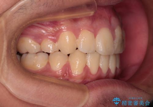 膨らんだ口元 ワイヤー装置での抜歯矯正の治療後