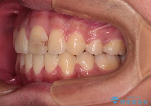 膨らんだ口元 ワイヤー装置での抜歯矯正の治療後